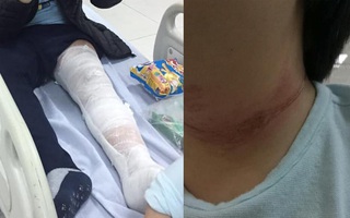 Hà Nội: Sự thật về thông tin 2 cháu bé ngồi sau xe mẹ ngã gãy chân vì bị thanh niên thòng dây vào cổ