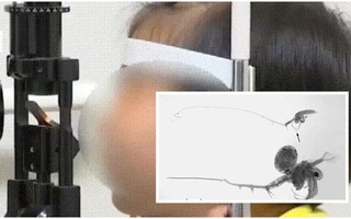 Con gái kêu ngứa mắt, mẹ đưa con đi khám thì sợ hãi biết trong mắt bé có đến 20 con rận