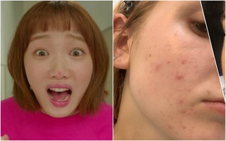 Bạn hay bị mụn ở vị trí nào? Bác sĩ sẽ chỉ ra nguyên nhân và cách chữa trị chuẩn nhất