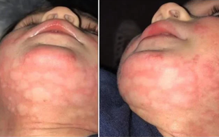 Dị ứng thức ăn – mối nguy hiểm tiềm ẩn ngay cả trong các khu vui chơi mà nhiều bố mẹ không thể ngờ tới