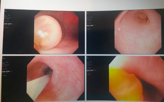 Con trai ăn gì nôn nấy, mẹ đưa đi khám thì choáng váng khi biết có thứ đồ chơi trẻ em này nằm trong ruột con
