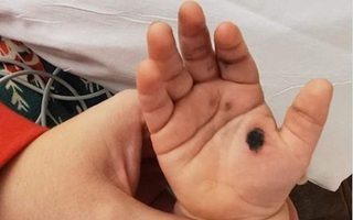 Thêm hình ảnh bàn tay bé bị cháy đen vì sạc điện thoại, cảnh báo bố mẹ thiết bị này "không đùa được đâu"