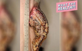 Kinh hãi chiếc "sừng rồng" trên lưng người đàn ông - hệ quả của ung thư biểu mô tế bào vảy