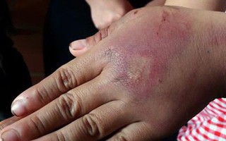 Phẫn nộ bố nghiện ma túy nhiều lần trói con gái 8 tuổi vào cột đánh đập dã man, thâm tím khắp người