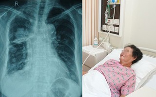 Chỉ sốt nhẹ và ho khan 2 tuần, người phụ nữ bất ngờ phát hiện mắc căn bệnh ung thư phổi