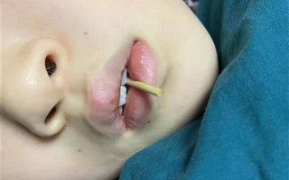 Vừa ăn hotdog vừa chơi trên giàn nhún, cô bé 10 tuổi gặp tai nạn kinh khủng đến giờ vẫn chưa qua được nguy hiểm