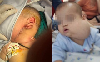 Người mẹ Sài Gòn đau khổ tột cùng vì con trai 12 tháng tuổi mang "gương mặt quỷ", má phình to như quả bưởi