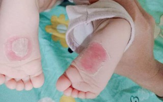 Em bé Hà Nội bị bà giúp việc đắp tỏi để chữa ho, nào ngờ hậu quả đau lòng lại xảy ra khiến bé bỏng nặng, nhập viện gần 2 tuần mới khỏi