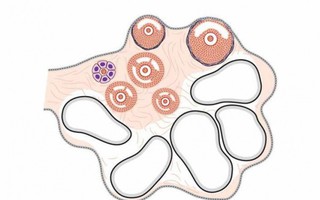Những người có nguy cơ mắc xoắn buồng trứng?