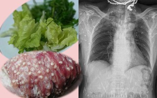 Từ vụ nhiễm sán lợn: Đây mới là căn bệnh kinh hoàng nhất do nhiễm sán