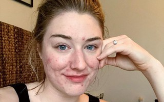 Rất chăm chỉ skincare nhưng vẫn bị mụn, nguồn cơn có thể đến từ 5 điều nhỏ xíu mà tai hại vô cùng này 