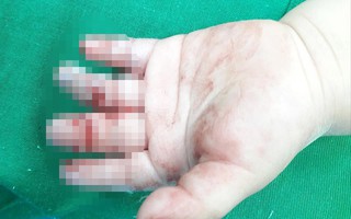 Bé trai 16 tháng tuổi bị máy xay thịt cuốn dập nát, hoại tử ngón tay