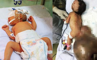 Mổ thành công cho bé gái sơ sinh mang khối bướu "khổng lồ" vùng cùng cụt nặng hơn cả trọng lượng cơ thể