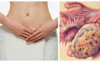 Những biểu hiện tưởng không liên quan đến cơ quan sinh sản nhưng hóa ra lại cảnh báo ung thư phụ khoa