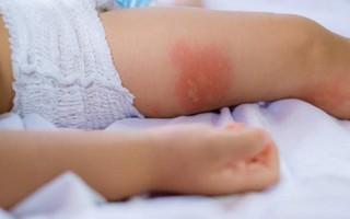 Đây chính là điều cha mẹ nên lo lắng khi con cái thường xuyên bị muỗi đốt