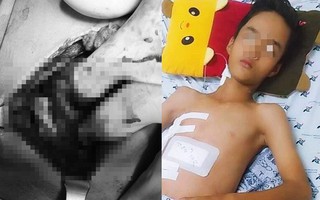 Tai nạn đau lòng: Đi làm mướn nuôi cha tâm thần, bé trai 13 tuổi bị thanh sắt máy cắt lúa đâm xuyên thấu ngực