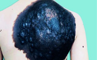 Bé trai 7 tuổi ở Vĩnh Long mang khối u "khổng lồ" hiếm gặp vùng lưng như chiếc mai rùa