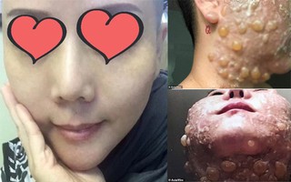 "Phẫu thuật" căng da mặt khiến cả khuôn mặt người phụ nữ bị bao phủ trong những vết phồng rộp kinh hoàng