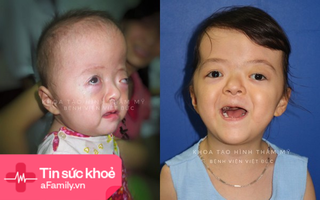 Kì tích cho bệnh nhân nhi mắc hội chứng hẹp hộp sọ phức tạp hiếm có trên thế giới tại Việt Nam