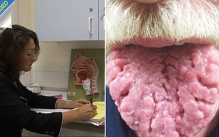 Lưỡi biến dạng kinh dị - hóa ra đó là triệu chứng cảnh báo sớm của bệnh ung thư cực hiếm gặp