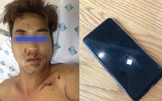 Tai nạn nguy hiểm: Vừa sạc pin vừa nói chuyện điện thoại, thanh niên 29 tuổi suýt nát mặt, mất bàn tay