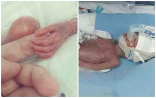 Bé trai sinh non 4 tháng, nặng chưa đến 1 kg với kích thước cơ thể nhỏ đến mức không thể tưởng tượng được