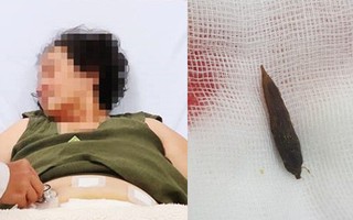 TP.HCM: Người phụ nữ nguy kịch vì bị hạt chà là đâm thủng ruột trong lúc ăn