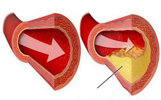 Bệnh mỡ máu cao "không trừ một ai": Muốn không có bệnh thì nên chú ý 7 điều quan trọng