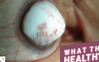 Sau phẫu thuật đục thủy tinh thể, tròng trắng trong mắt người đàn ông lồi cả ra ngoài