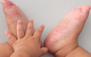 Bệnh tay chân miệng: Trẻ bị lây truyền qua đường nào và khi nào thì trẻ bị tay chân miệng hết lây cho người khác?