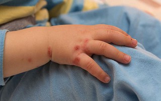Trong 1 tuần có thêm 14 ca mắc tay chân miệng: Đây là dấu hiệu bệnh tay chân miệng và việc cha mẹ cần làm ngay để phòng bệnh cho con