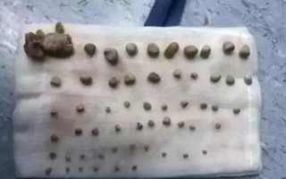 Bé 9 tuổi có 56 viên sỏi trong thận do thói quen ăn nhiều thịt