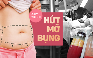 Hút mỡ bụng được chuyên gia thực hiện theo các bước như thế này, bước thứ 2 cực kì quan trọng