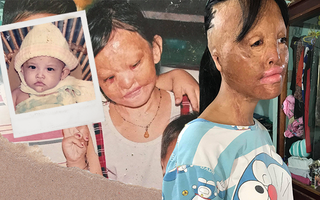 Bé gái biến dạng khuôn mặt, mất một bên tai và ước mơ nhói lòng: "Em muốn làm họa sĩ để vẽ mình đẹp hơn"