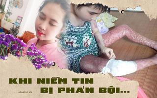 Nỗi đau của người vợ bị chồng tẩm xăng thiêu sống, bỏng 79% cơ thể: Hi sinh tất cả vì 1 người đàn ông rồi cuối cùng suýt mất cả mạng
