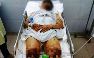 Nhận dạng nghi phạm tạt axit, cắt đứt gân chân nam Việt kiều: Người gầy, nói giọng Bắc