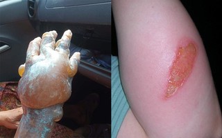 Từ hình ảnh dùng kem đánh răng chữa bỏng khiến bàn tay sưng phồng nghiêm trọng, bác sĩ khuyến cáo việc nên làm khi bị bỏng
