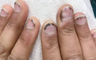 Dấu hiệu bất thường ở móng tay cảnh báo bệnh viêm van tim ít ai biết