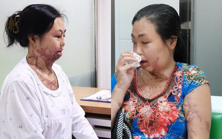 Vừa chia tay chồng, người phụ nữ bị kẻ lạ tạt axit, đau đớn khi con trai 8 tuổi sợ hãi, không nhận ra mẹ