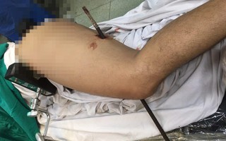 TP.HCM: Trượt té từ công trình xuống đất, người đàn ông bị thanh sắt dài đâm xuyên cơ thể