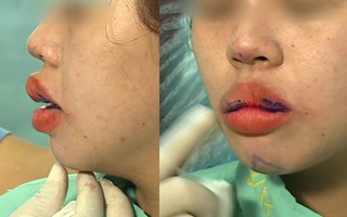 Nhiều thiếu nữ dưới 18 tuổi ở Anh bơm môi và nhận cái kết đắng: Chuyên gia chỉ ra thứ chị em cần để ý khi muốn tiêm chất làm đầy môi