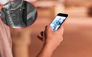 Điện thoại di động làm thay đổi bộ xương của con người: Chỉ vì nghiện smartphone mà nhiều người mọc gai nối dài ở sọ