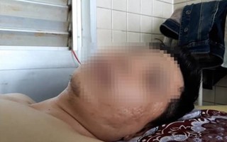 Bị gãy đốt sống ngực nhưng bác sĩ lại... khoan cẳng chân: Bệnh viện lên tiếng ‘khoan nhầm nhưng vết thương sẽ tự lành’