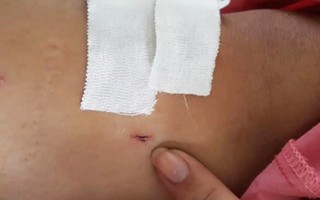 Vụ người đàn ông gãy đốt sống ngực nhưng khoan nhầm chân: Tạm đình chỉ 2 cán bộ liên quan