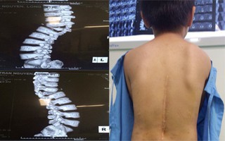 Áp dụng kỹ thuật hiện đại: Bé trai gù vẹo cột sống phức tạp được phẫu thuật thành công trở lại bình thường