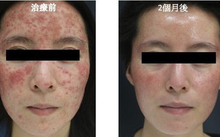 Cô gái bị viêm da suốt 6 năm, cứ 1cm² trên mặt có 528 con ký sinh trùng trên da