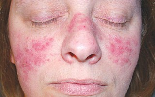 Mẹ bầu mắc lupus ban đỏ dễ gặp nguy cả mẹ lẫn con