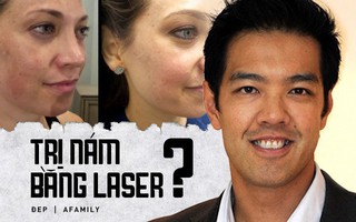 Với làn da Châu Á, các chị em đừng nên coi laser là phương pháp thần kỳ để trị nám