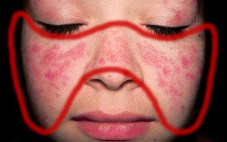 Đã có những sản phụ nguy kịch tính mạng của cả mẹ và con vì bệnh lupus ban đỏ: Nguyên nhân bệnh lupus ban đỏ là gì?