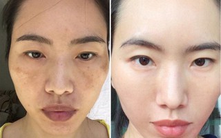 Chỉ cần nhìn vào 2 bên gò má sẽ biết ngay bạn đang bị nám hay đốm nâu 